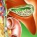 How to alleviate your condition when bile is thrown into the stomach?
