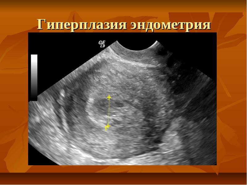 Эндометрия стенок матки. Эхограмма гиперплазии эндометрия. Гиперплазия эндометрия на УЗИ.